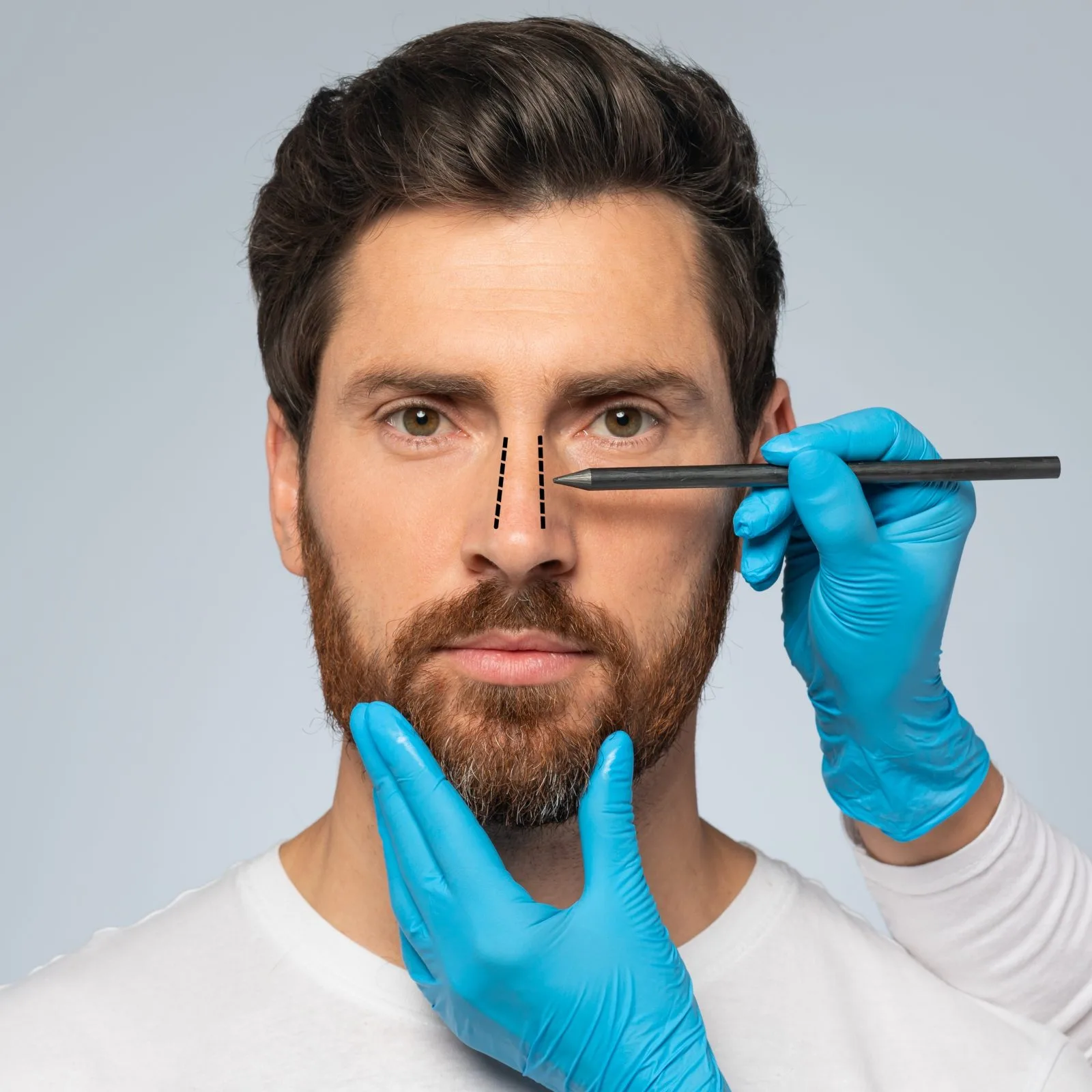 Surgeon in blue gloves marking rhinoplasty procedure lines on patient's nose bridge